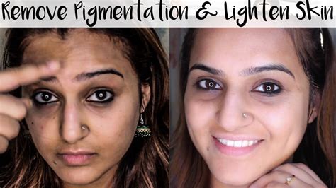 How To Get Rid Of Pigmentation Dark Spots Discoloration Lighten