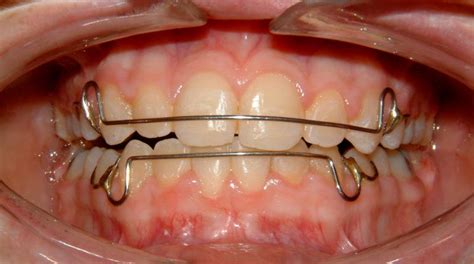 They would say, okay, how long do i have to wear my retainers? Vu Orthodontics - Services
