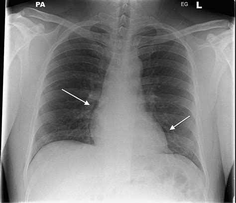Spontaneous Pneumomediastinum An Important Differential In Acute Chest