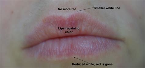 Why Is The Area Around My Lips White Lipstutorial Org