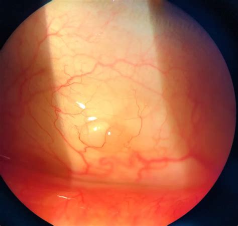 Conjunctival Inclusion Cyst Eyewiki