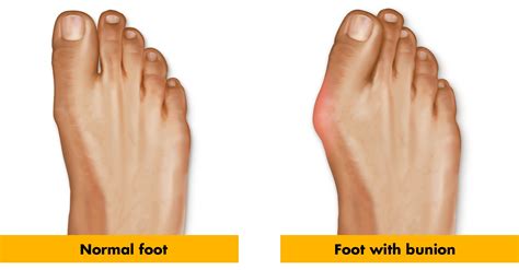 Bunion Pain Common Causes And Symptoms Stryker