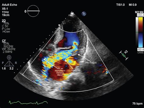 Atrial Septal Aneurysm Associated With Mitral Valve Prolapse Syndrome