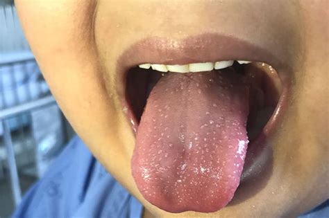 Covid Symptoms On Tongue Mum S Warning As Children Suffer Symptoms Of