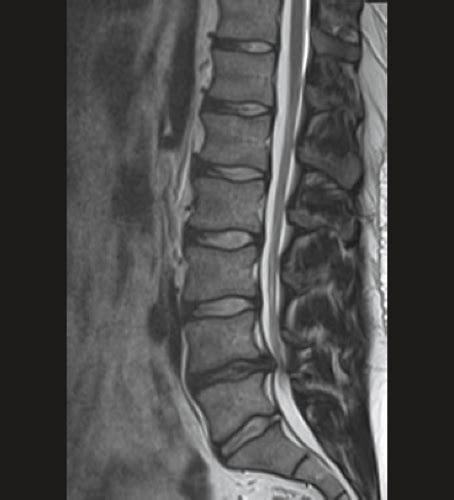 Lumbar Degenerative Disk Disease And Spinal Stenosis In Athletes