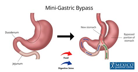 Mini Gastric Bypass Vs Mini Gastric Sleeve Mexico Bariatric Center