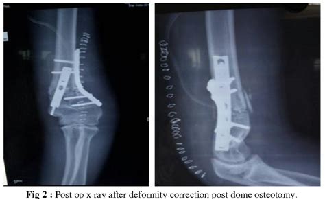 Figure 2 From Our Experience Of Dome Osteotomy In Cubitus Varus