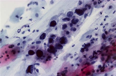 Lm Of Cervical Smear Showing Severe Dysplasia Photograph By Dr E