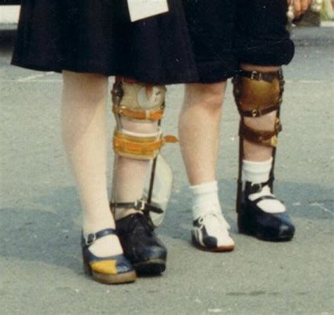 Leg Brace Girlscopy1 Flickr Photo Sharing