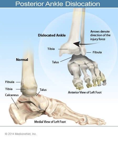 Dislocated Ankle Facts On Symptoms Treatment And Recovery