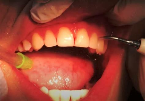 Does Anemia Cause Gums To Bleed How To Treat It