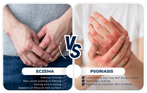 Eczema Psoriasis Ko Skin Specialist