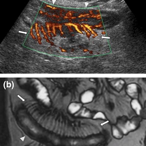 Terminal Ileitis In A 37 Year Old Woman A B Mode Us Depicts A Markedly