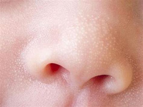 Uae What Does My Childs Skin Rash Mean Gulf News