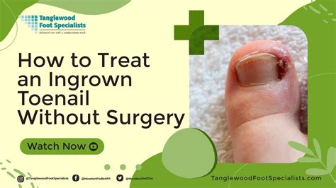 How To Treat An Ingrown Toenail Without Surgery Youtube