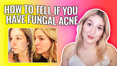 How To Tell If You Have Fungal Acne Malassezia Folliculitis Youtube