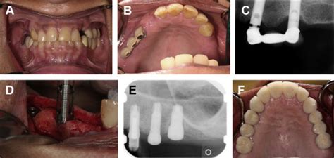 Management Of Implantprosthodontic Complications Pocket Dentistry