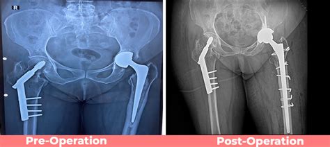 Revision Complex Total Hip Replacement Sant Parmanand Hospital