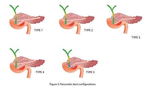 Cureus Pancreatic Duct Variations And The Risk Of Post Endoscopic