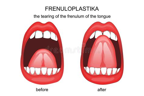 frenuloplastika the tearing of the frenulum of the tongue stock vector illustration of