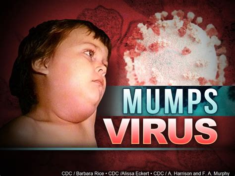 Mumps Confirmed On U Of A Campus Dept Of Health Warns