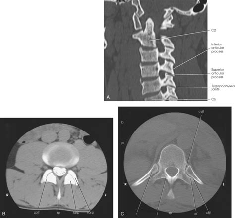 Hess describes how medical imaging can be used for back pain reduction, treat vertebral bodies and sacral fractures. VERTEBRAL COLUMN | Radiology Key