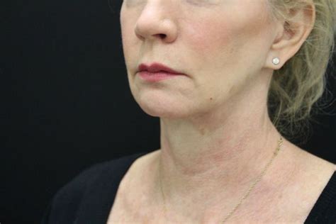Case 22 Face And Neck Lifts Before And After Gallery