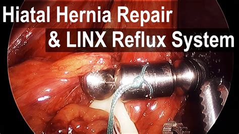 LINX Hiatal Hernia Repair To Treat Reflux Animation And Surgical