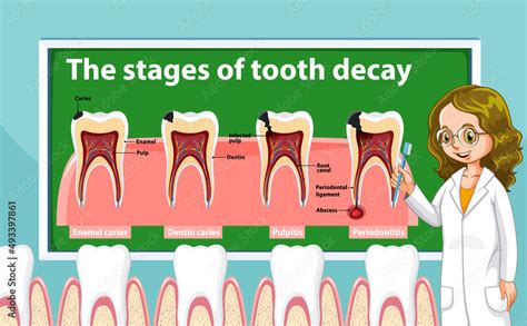 Infographic Of Human In The Stages Of Tooth Decay Stock Vector Adobe