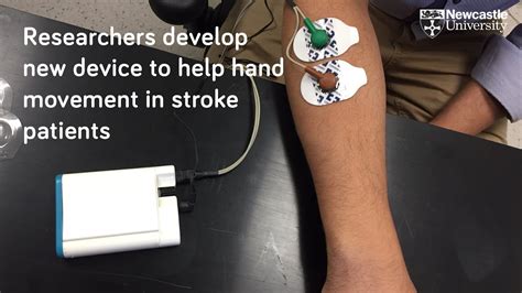 Device To Help Stroke Patients Recover Hand Movement Youtube