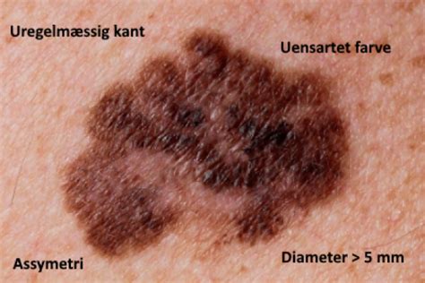 Melanom, derinin rengini sağlayan melanosit denilen pigment hücrelerdeki kanserdir. - Sygdomsguiden
