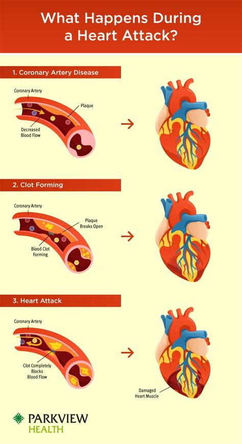 What Happens During A Heart Attack In 2021 Heart Disease Awareness