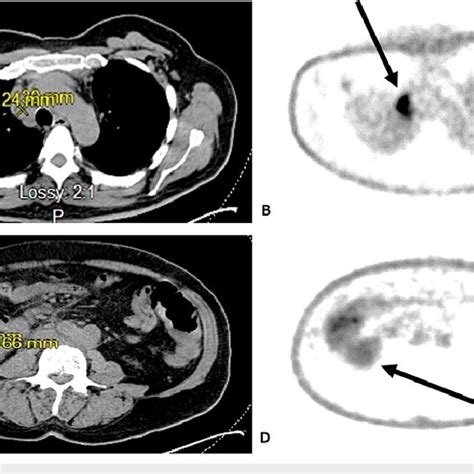 Ct Scan Demonstrating The Diffuse Pelvic Lymphadenopathy The