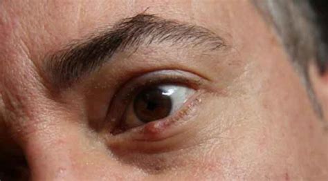 Ingrown Eyelashes How To Remove Get Rid Upper Lower Eyelid Stye