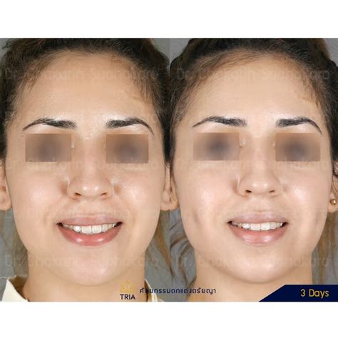Dimple Plasty Before Anf After Surgery It Enhance The Face Of This