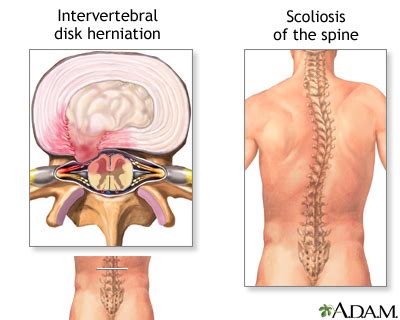 Spinal Fusion Seriesindications Medlineplus Medical Encyclopedia