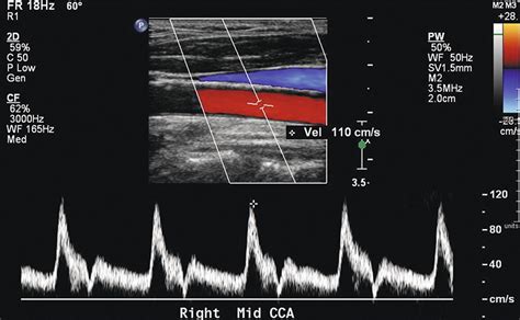 Carotid Endarterectomy Ultrasound