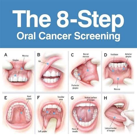 Oral Cancer Risk Symptoms And Prevention Ladys Island Sc Dentist Office