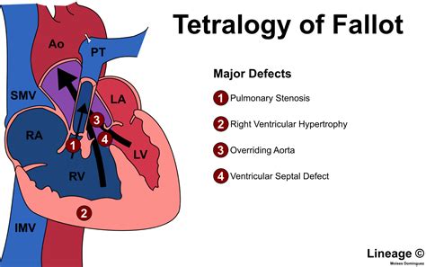 Tetralogy Of Fallot Cardiovascular Medbullets Step 1