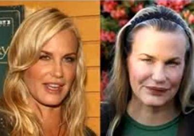 Celebrity Before And After Plastic Surgery Disasters Vrogue