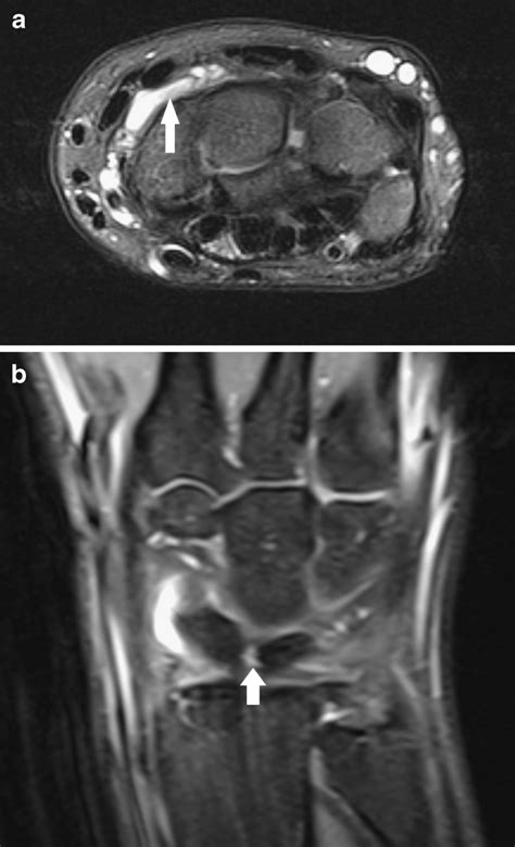 Small Dorsal Ganglion Cyst A Axial Fs T Wi Note A Well Delineated Download Scientific