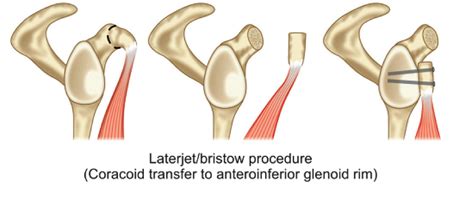 Arthroscopic Surgery For Recurrent Shoulder Dislocation Ligaments And