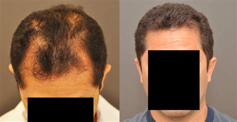Neograft Automated Fue Hair Transplant Shortens Procedure Time And