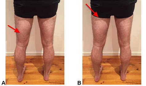 Hamstring Injury Causes Symptoms Recovery Time Treatment