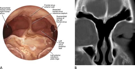 Advances In Endoscopic Frontal Sinus Surgery Operative Techniques In