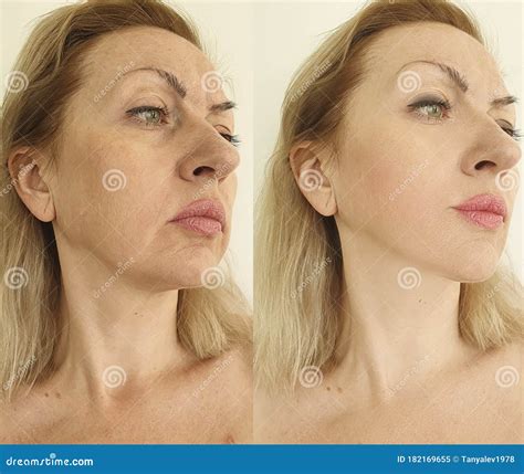 Woman Face Wrinkles Before And After Tightening Double Chin Treatment