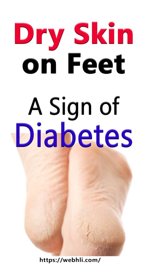 Dry Skin On Feet A Sign Of Diabetes Healthy Lifestyle