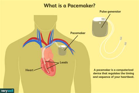 How Does A Pacemaker Work