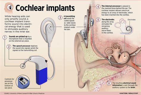 Cochlear Implants Explica Media