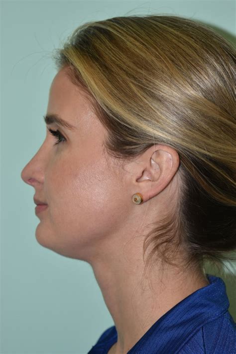 Rhinoplasty Davis Facial Plastic Surgery